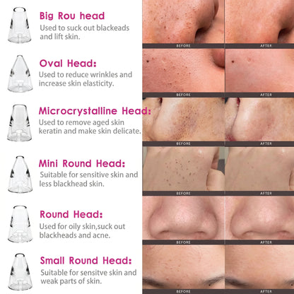 6 in 1 Multi-function Blackhead Remover Tools
